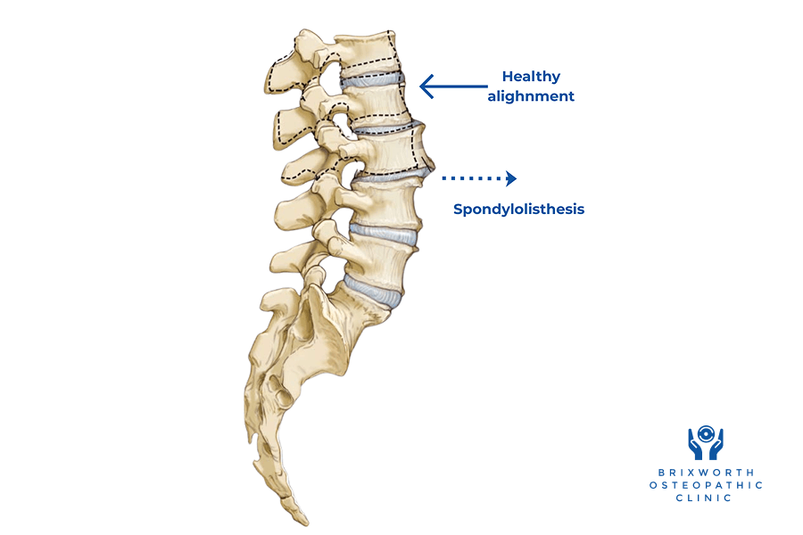 Diagram showing Spondylolisthesis